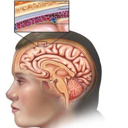 диагностика менингита