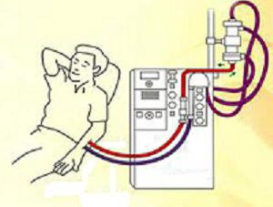 гемодиализ почек