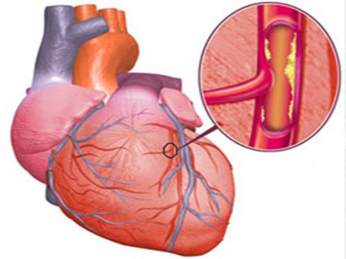 ИБС симптомы