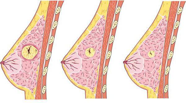 фиброаденома молочной железы что это такое