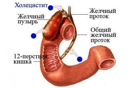 дифференциальный диагноз хронического калькулезного холецистита