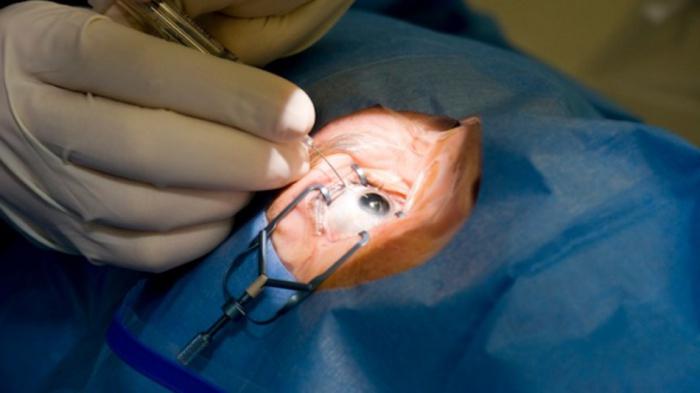 Операция на глаза лазером