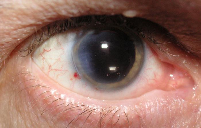 Операция на глаза катаракта