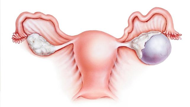лечение кисты яичника без операции