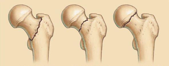 Перелом шейки бедра у пожилых людей