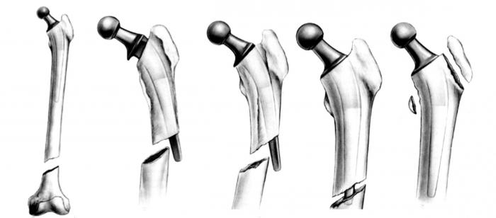 перелом шейки бедра у пожилого человека что ждать