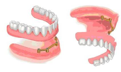 как крепится покрывной зубной протез