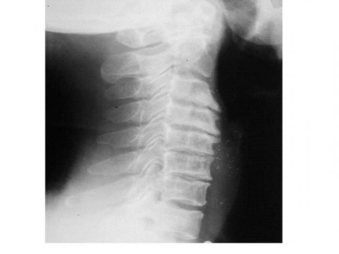 остеохондроз спондилез шейного отдела позвоночника 