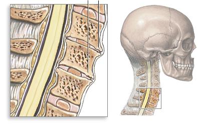 спондилез шейного отдела позвоночника 
