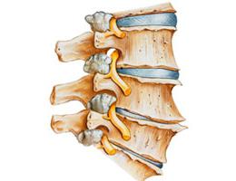 поясничный спондилез