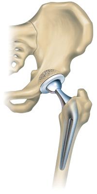  протез тазобедренного сустава