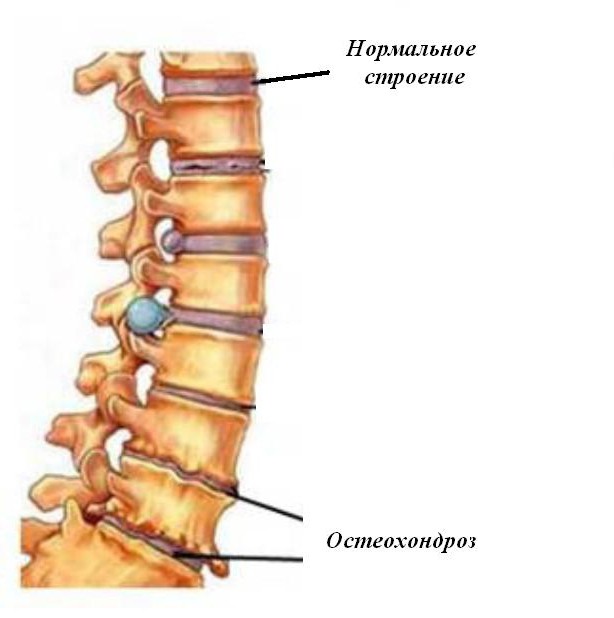 как вылечить остеохондроз