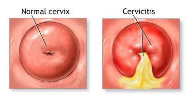 эндоцервицит лечение