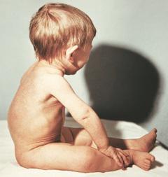 туберкулез у детей до года симптомы