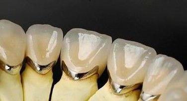 поставить зубы металлокерамика