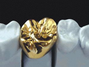 металлокерамика зубы отзывы