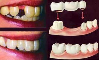 зубы металлокерамика до и после
