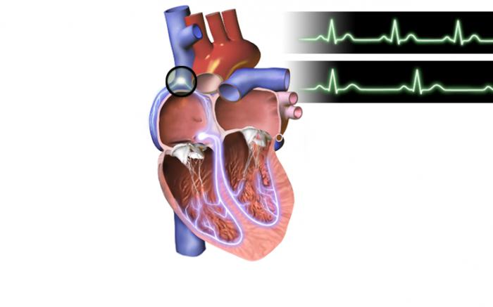 Что такое синусовая брадикардия сердца