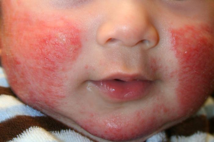 пероральный дерматит у детей лечение