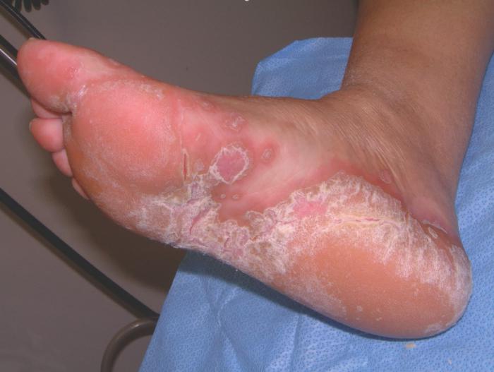грибок на коже ног