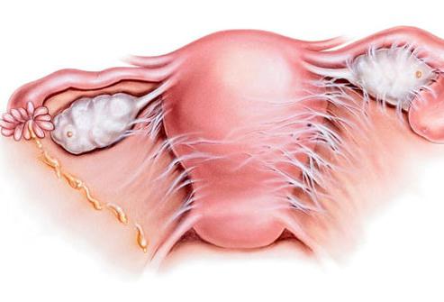 воспаление придатков у женщин