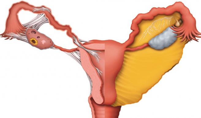 лечение придатков у женщин