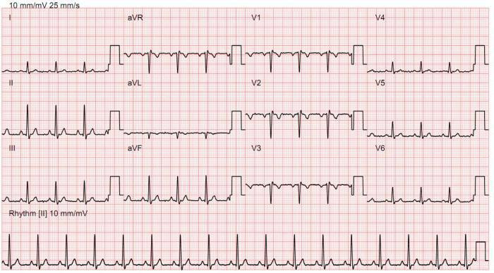 кардиограмма сердца
