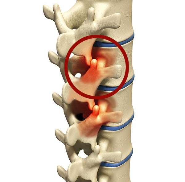 дегенеративно дистрофические изменения позвоночника лечение