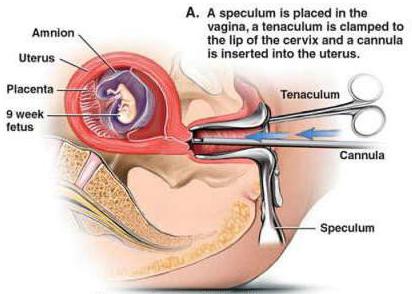 месячные после хирургического аборта