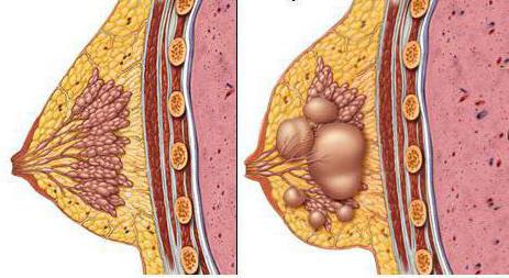 что такое мастопатия