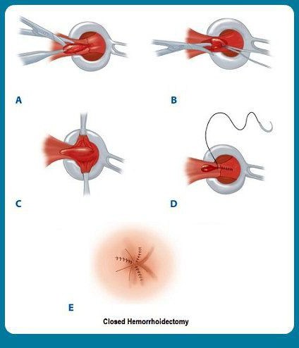 операция на геморрой 