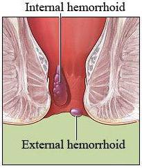 лечение геморроя после операции 