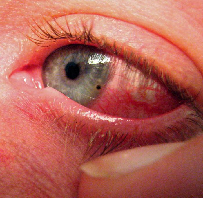 Ожог глаза сваркой лечение в домашних условиях