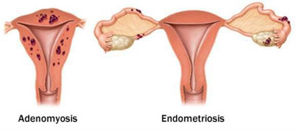 как остановить маточное кровотечение при гиперплазии эндометрия