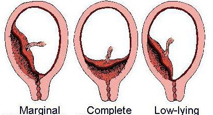 краевое предлежание плаценты лечение чем грозит
