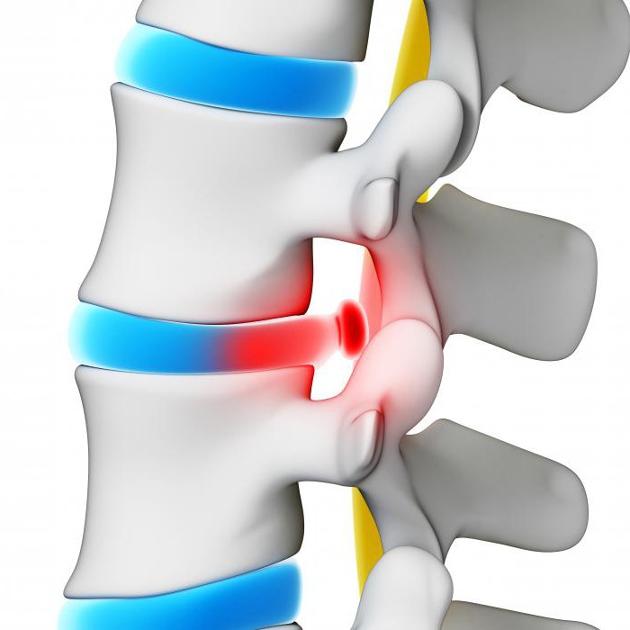 Грыжа диска