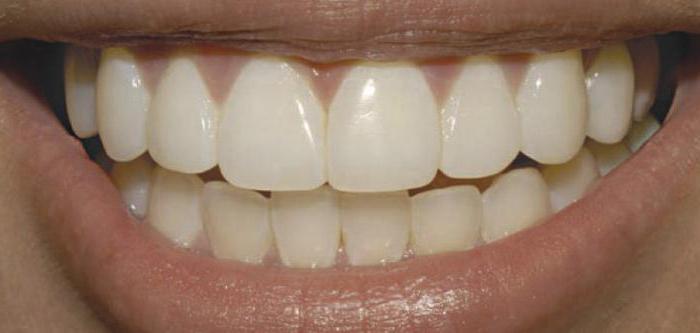 циркониевые коронки на передние зубы