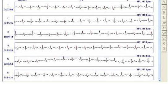 Мониторирование ЭКГ по Холтеру