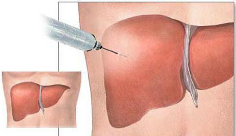 в каких случаях делают биопсию печени
