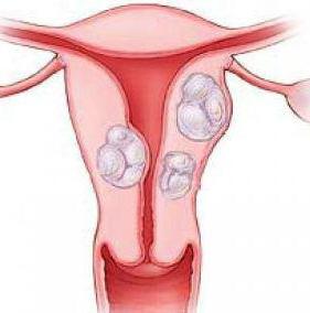 как лечить миому матки без операции