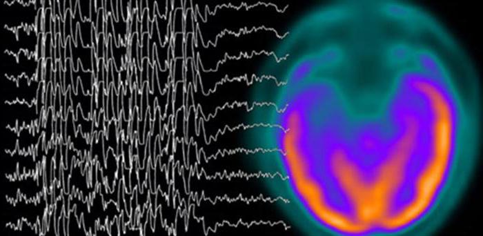  электроэнцефалография головного мозга