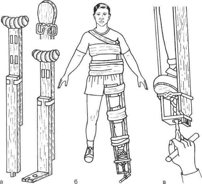 транспортная иммобилизация шиной дитерихса