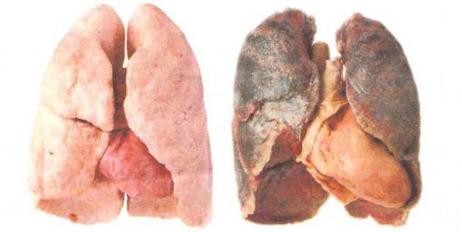 рентген легких курильщика и здорового человека 