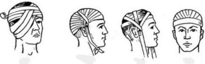 правила наложения повязок