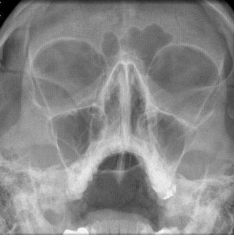 рентген придаточных пазух носа