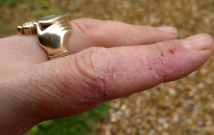 Трескается кожа на пальцах рук около ногтей грибок