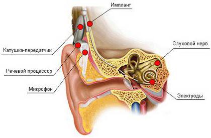 кохлеарный имплантат 