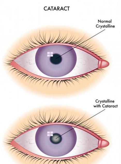 катаракта глаза лечение народными средствами