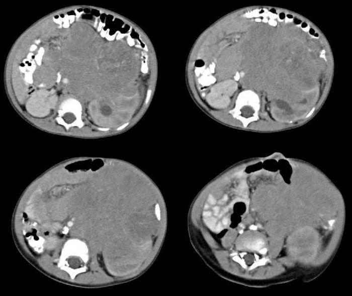 нейробластома у детей 4 стадия