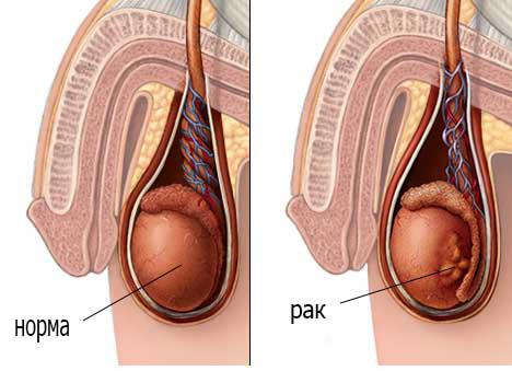  признаки рака яичек у мужчин